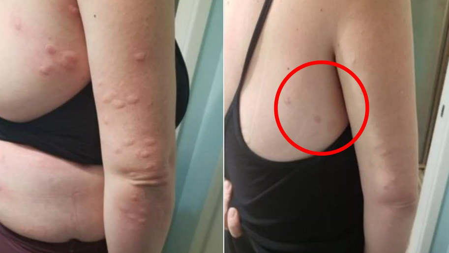 Bug Bite Thing® (4)